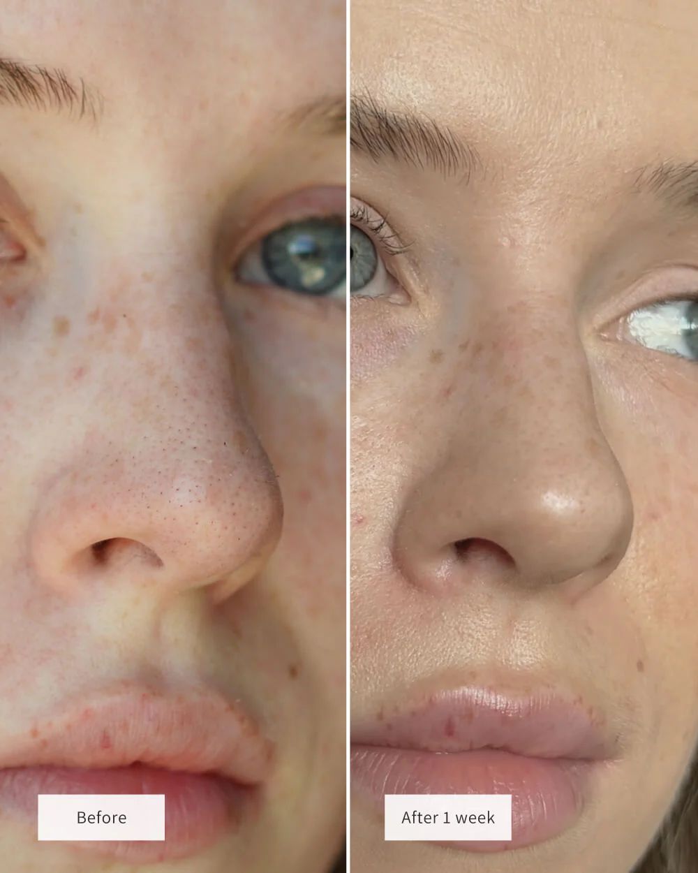 💰Free Shipping📦NOSE PATCHES