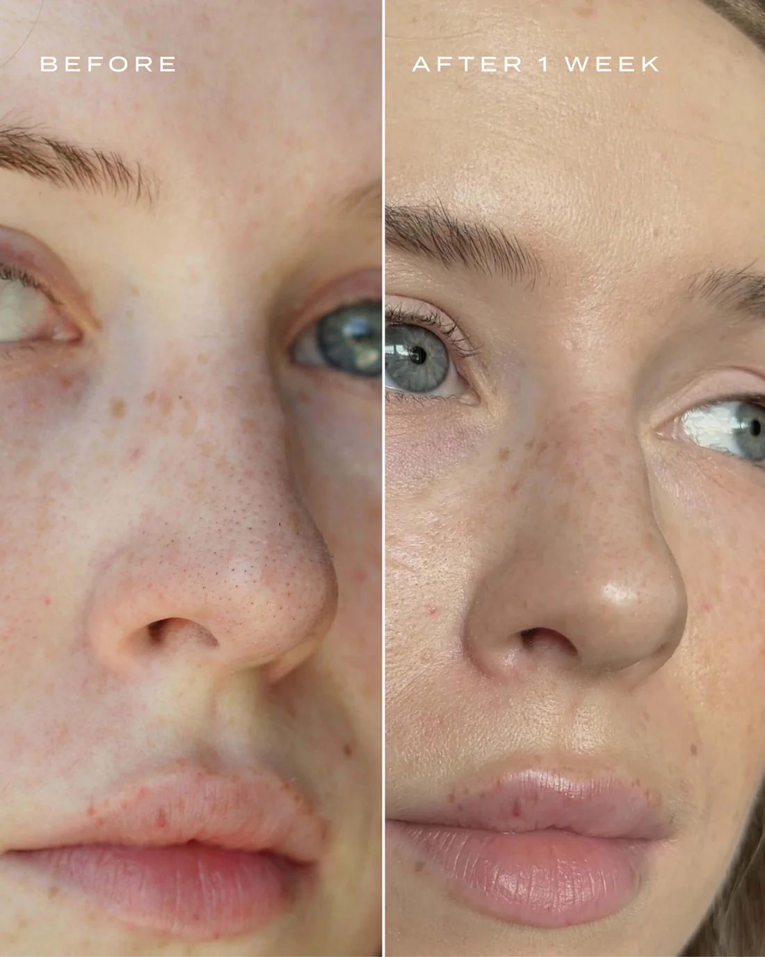 💰Free Shipping📦NOSE PATCHES